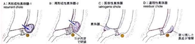 腫 真珠