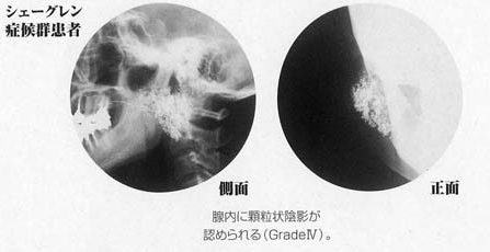 診断 シェーグレン 症候群 診断基準と解説