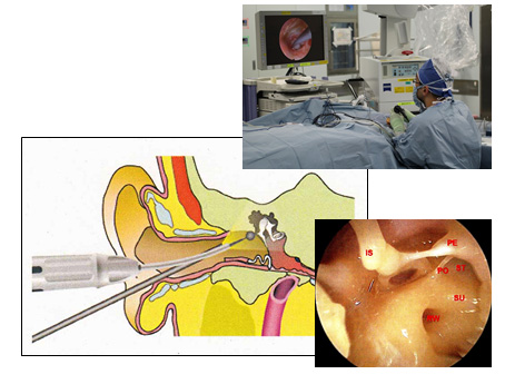 内視鏡下耳科手術：Transcanal endoscopic ear surgery（TEES）