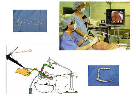 内視鏡的咽喉頭手術：endoscopiclaryngo-pharyngeal surgery（ELPS）